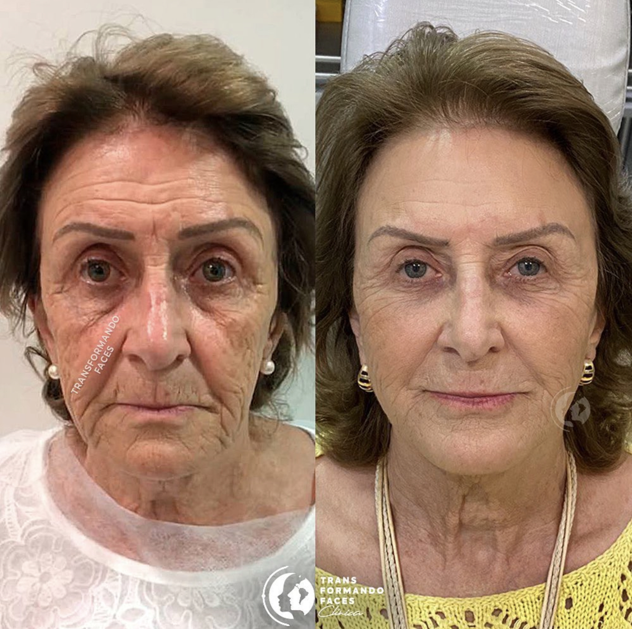 Antes e depois — Estrutura facial recuperada e rugas suavizadas