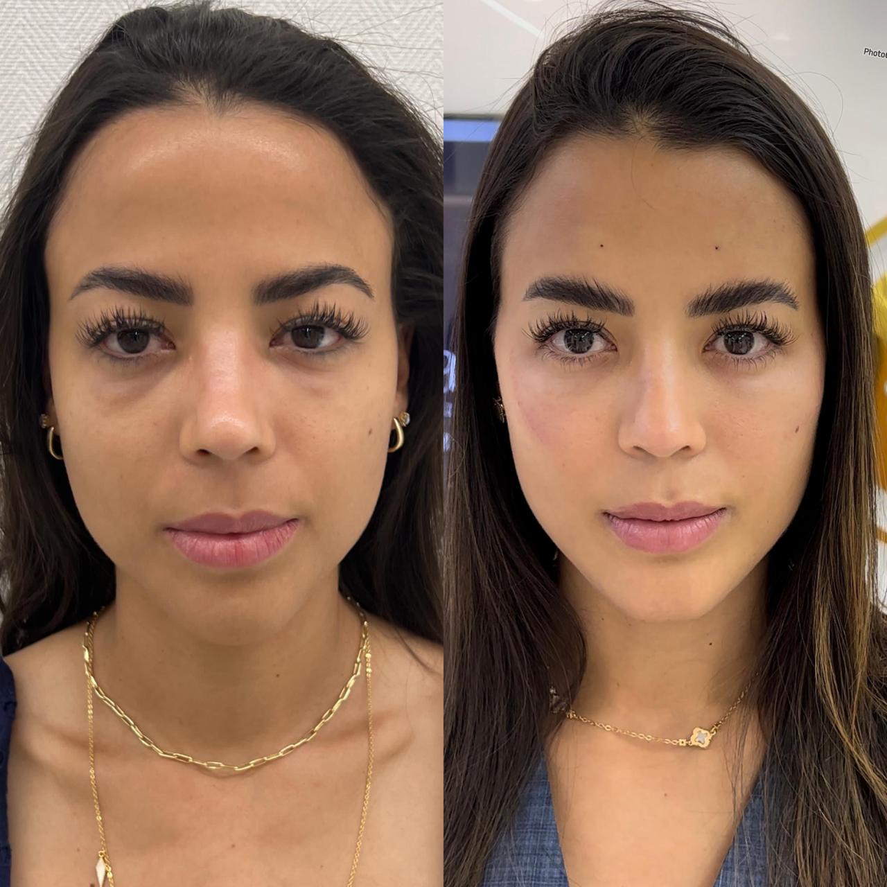 Antes e depois — Olheiras atenuadas e frescor do olhar