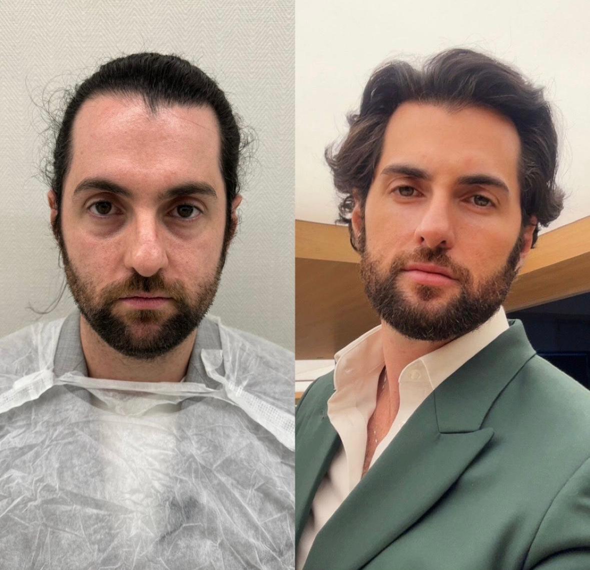 Antes e depois — Resultado masculino com traços preservados