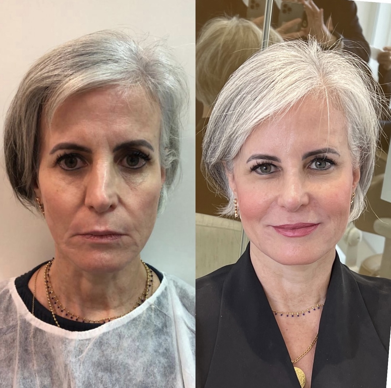 Antes e depois — Contorno facial e luminosidade da pele
