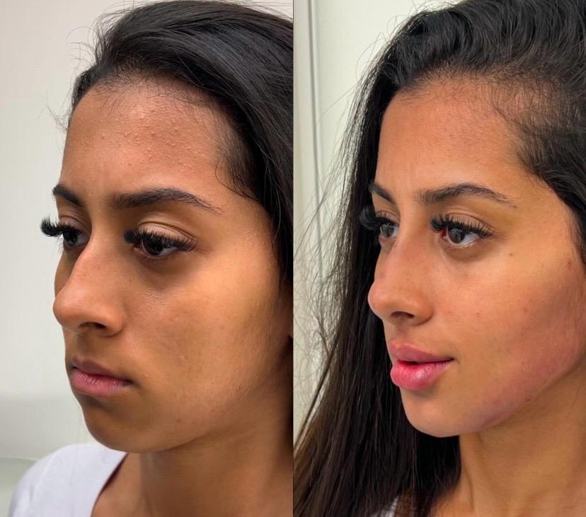 Antes e depois — Perfil equilibrado e textura de pele renovada